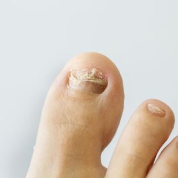 Lone Star Family Health Center: Walk confidently in your shoes by taking care of your toenails