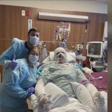 Houston man survives having 90% of his body burned
